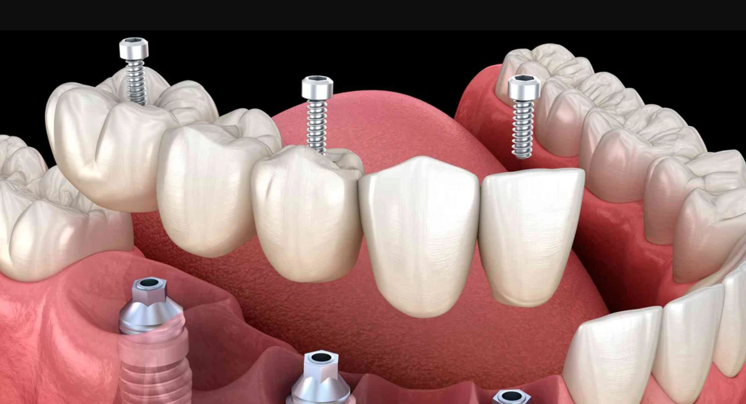 Prótesis Dentales